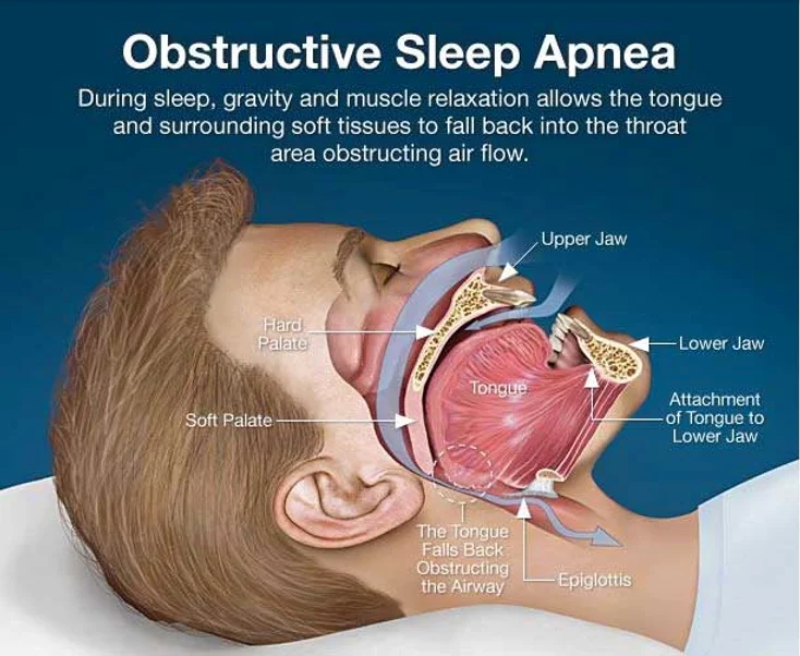 Can Sleep Apnea Be Cured Senior Plus